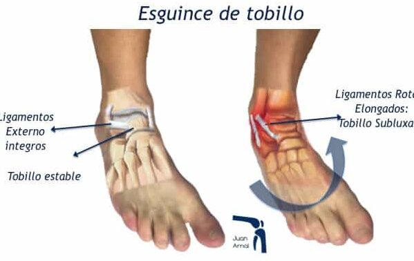 ligamentos del tobillo todo lo que debes saber